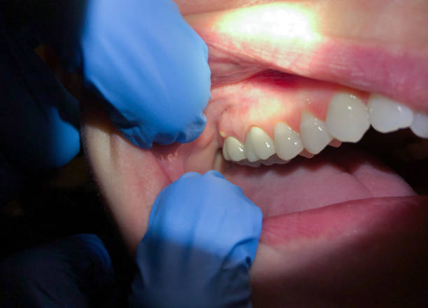 Best Emergency Dental Care for Abscessed Tooth in Chester Heights, PA
